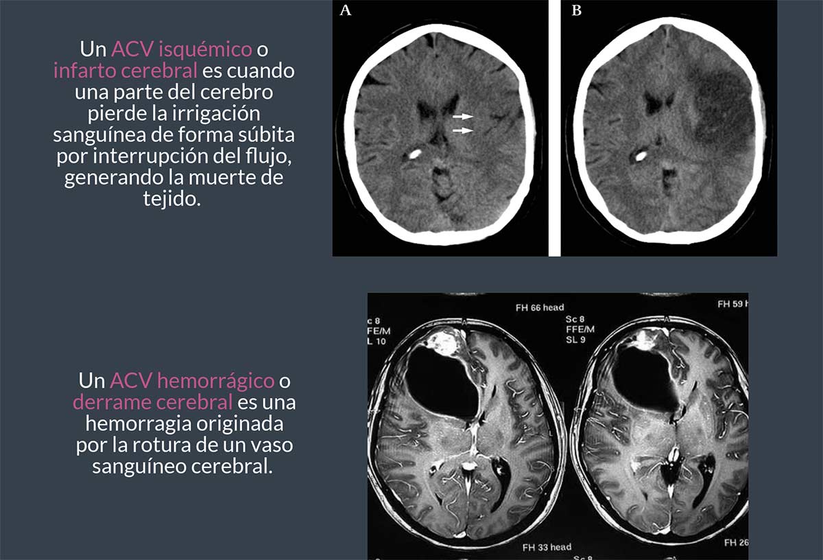 Demencia Vascular Fundalzheimer Costa Rica